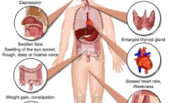 signs symptoms of hypothyroidism