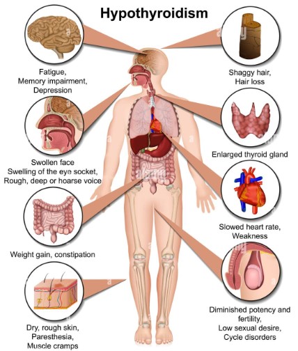 signs symptoms of hypothyroidism